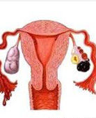 卵巢朱古力囊腫 卵巢朱古力囊腫