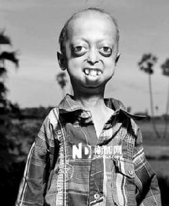 印度早衰少年 印度早衰少年