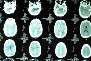 多灶性運動神經病