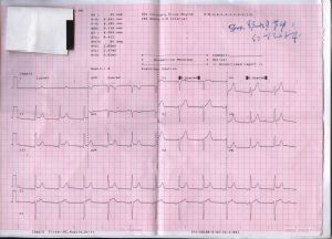 早期復極綜合徵 早期復極綜合徵