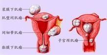 漿膜下肌瘤 漿膜下肌瘤