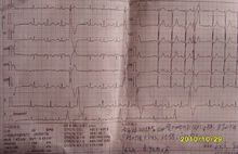 室性早搏的心電圖