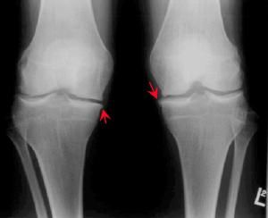  膝關節退行性關節炎