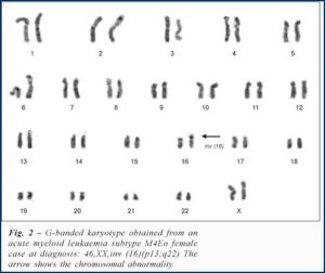 急性淋巴細胞性白血病染色體易位