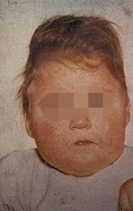 四氫生物蝶呤缺乏症 四氫生物蝶呤缺乏症