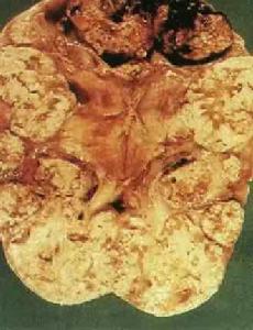 腎結核對側腎積水