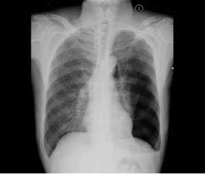 肋軟骨炎X光圖片