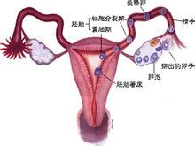 輸卵管不孕
