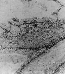 混合性結締組織病