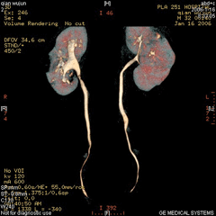 腸系膜上動脈綜合徵 腸系膜上動脈綜合徵