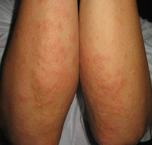 日光性皮炎 日光性皮炎