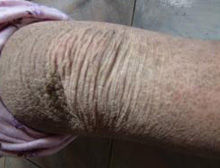 陪拉格拉病 陪拉格拉病