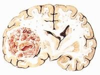星形腦瘤 星形腦瘤