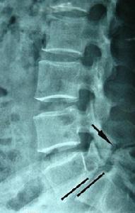 腰椎滑脫 腰椎滑脫