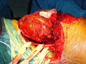 （圖）肝臟類癌