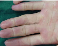 雷諾氏病 雷諾氏病