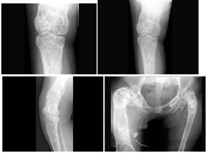 蠟油樣骨病 蠟油樣骨病