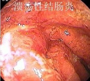 潰瘍性結腸炎患者慎用