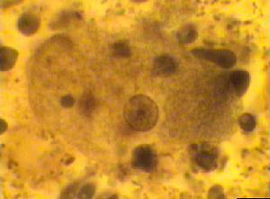 溶組織內阿米巴