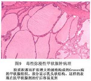 毒性瀰漫性甲狀腺腫