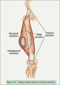 骨與軟組織腫瘤