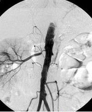 腎動脈狹窄 腎動脈狹窄