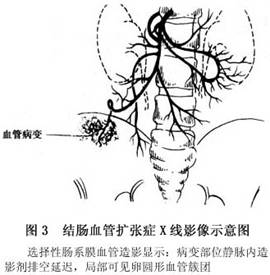 結腸血管擴張症