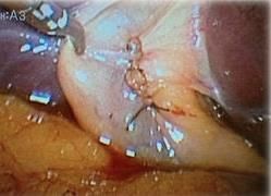 保膽取石 保膽取石