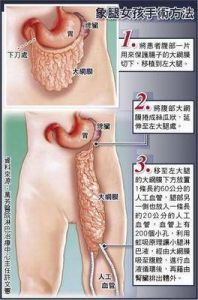 象腿病 象腿病