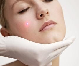 彩光祛斑 彩光祛斑