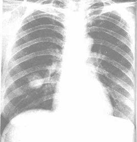 肺部炎性假瘤 肺部炎性假瘤