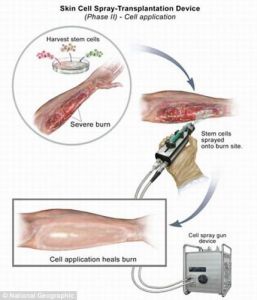 使用皮膚噴槍對傷口處進行治療