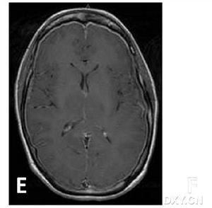 顱內低壓綜合徵