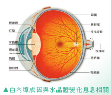 糖尿病性白內障