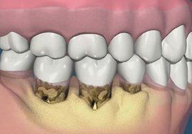 牙床萎縮 牙床萎縮