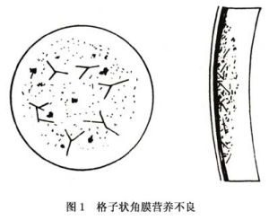 格子狀角膜營養不良