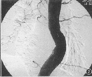 肝動脈瘤 肝動脈瘤