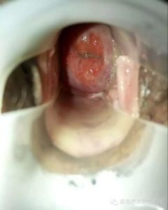 宮頸多發納囊 宮頸多發納囊