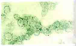 （圖）回盲腸綜合徵