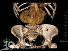 腎及輸尿管重複畸形