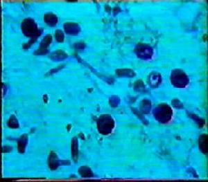 《寄生蟲感染》