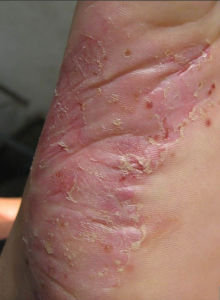 鱗屑角化型腳氣 鱗屑角化型腳氣