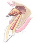 根尖切除術 根尖切除術