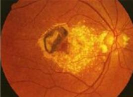 視網膜母細胞瘤 視網膜母細胞瘤