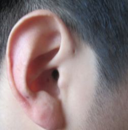 耳前瘺管 耳前瘺管