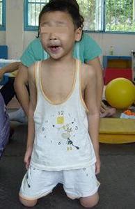 共濟失調型腦癱 共濟失調型腦癱