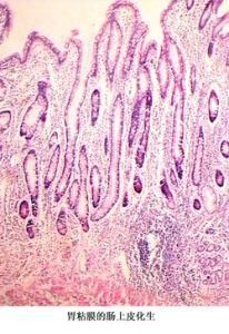 腸上皮化生 腸上皮化生