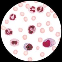 中性粒細胞核左移