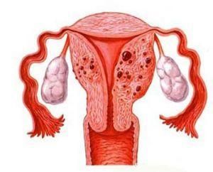 子宮腫瘤