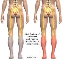 坐骨神經 坐骨神經